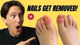 WATCH Painful Toenail Removal for Paronychia/Retronychia