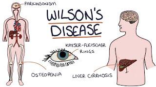 Understanding Wilson's Disease