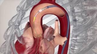 Transcatheter Aortic Valve Replacement (TAVR) for Aortic Stenosis