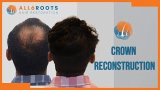 Crown Reconstruction | Hair Transplant by Dr Alok Sahoo | Patient Experience | Alloroots