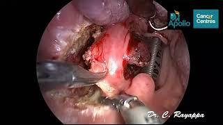 Recurrent Cancer of Tonsil | Transoral Ultrasonic Surgery - TOUSS | Dr. C Rayappa