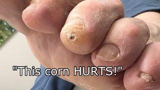 BIG TOE CORN 