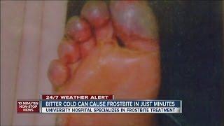 Bitter cold can cause frostbite in just minutes