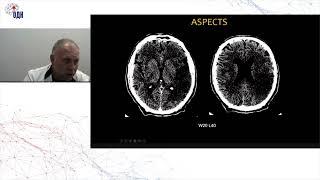 Экстренная нейровизуализация инсульта: что, когда и кому. к.м.н. Коновалов Родион Николаевич