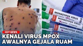 Apa Itu Virus Mpox yang Tren Disebut Cacar Monyet, Kenali Gejala dan Risiko Penularannya