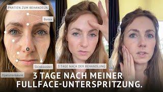 Teil 1: Meine erste Unterspritzung mit Hyaluronsäure und Botulinumtoxin. 3 Tage später.