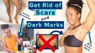 Get Rid of Hyperpigmentation, Scars, Dark Spots & Boil Scars on Your Body FAST | *Highly Requested*