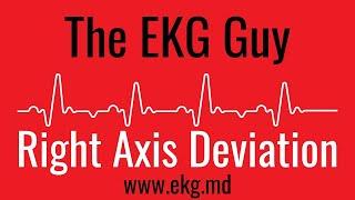 Right Axis Deviation on EKG / ECG l The EKG Guy - www.ekg.md