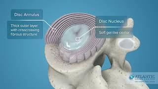 What is Cervical Degenerative Disc Disease? @AtlanticSpineCenter