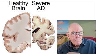 Vitamin D and dementia