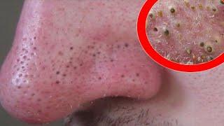 Removes acne, Давим прыщи, чёрные точки. Залипательно