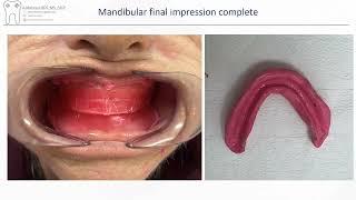 2-4 appointment complete denture technique