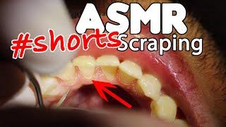 ASMR Dental Scraping Teeth #shorts #teethcleaning #plaqueremoval #plaque