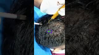 GFC Procedure for Hair Loss Treatment | GFC Treatment #shortsfeed