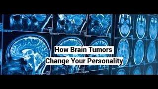 How Brain Tumors Change Your Personality