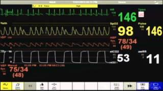 Cardiac Arrest - Patient Monitor