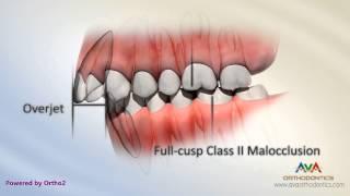 Malocclusion - Class II Div I