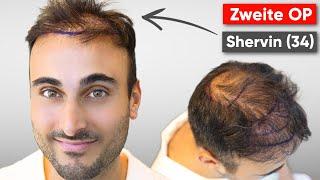 Shervins zweite Haartransplantation | Erfahrung (VLOG)