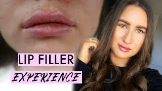 LIP FILLER EXPERIENCE | 1ML JUVEDERM ULTRA