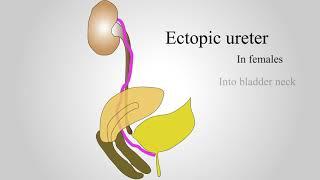 ectopic ureters