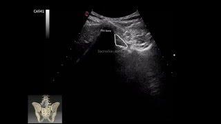 Ultrasonographic evaluation  of sacroiliac joint and piriformis muscle, by Murat Karkucak MD,