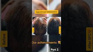 GFC hair growth treatment 9363223016 #gfc #hairfall #hairthinning#hairgrowth #chennai #haircare#hair