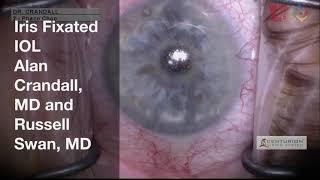 Surgery: Cataract Surgery Compilation Video: Teaching Pearls from the Moran Eye Institute