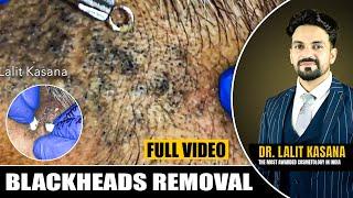 Blackheads Rmoval by Dr. Lalit Kasana's