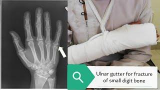 how to apply ulnar gutter| little finger fracture | orthopaedics | medico mnemonico