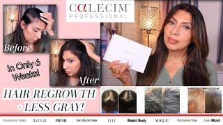 Calecim Advanced Hair System Gets REAL Results in 6 Weeks!