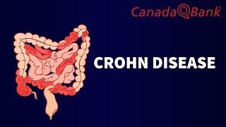 Crohn's Disease