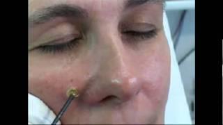 HF-Chirurgie_Elektrochirurgie_Dermatologie_Micromed_Medizintechnik.flv