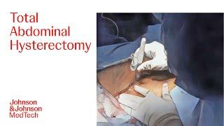 Total Abdominal Hysterectomy with ENSEAL X1 Large Jaw Tissue Sealer | J&J MedTech