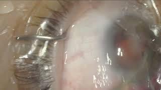 White Mature Cataract Removal