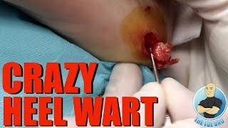 HUGE PAINFUL WART REMOVAL ON A CHILD