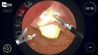 Salpingectomy