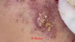 Pimple Removal and Acnes Treatment / B-Beauty /#07