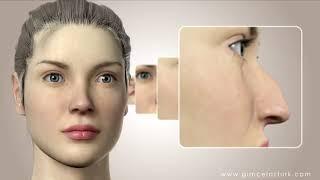 Ринопластика (Операция на носу) Анимационное видео - доктор Гунцель Озтурк