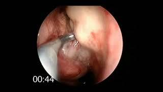 Balloon dilatation of Uncinate DNB ENT Osce Surgical Video Station DnbMentors