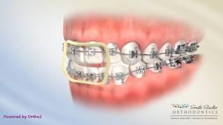 Elastics - Anterior Box - Orthodontic Treatment - Open Bite