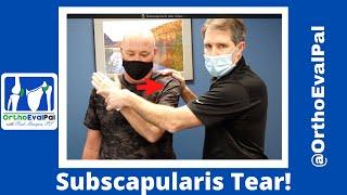 Subscapularis (Rotator Cuff) Tear