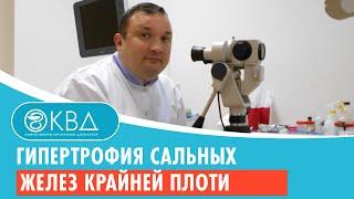 Гипертрофия сальных желез крайней плоти. Клинический случай №9