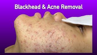 Relax Enjoy Today  Blackhead  Acne Removal