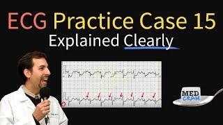 ECG / EKG Practice Case 15 - Step by Step Interpretation