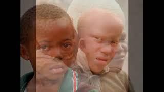 Что вы знаете об альбиносах в Африке?
