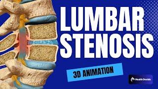 Lumbar Stenosis - 3D Animation
