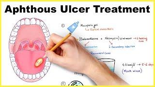 Aphthous ulcer/ stomatitis/ Canker sore  treatment