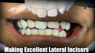 How to make an excellent Lateral Incisor