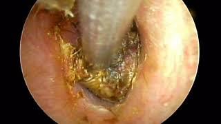 COCKROACH  IN RT  EAR  MIXED WITH WAX
