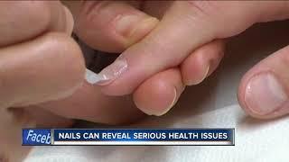 Doctors warn to check your nails for dangerous skin cancer